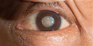 Cataracts