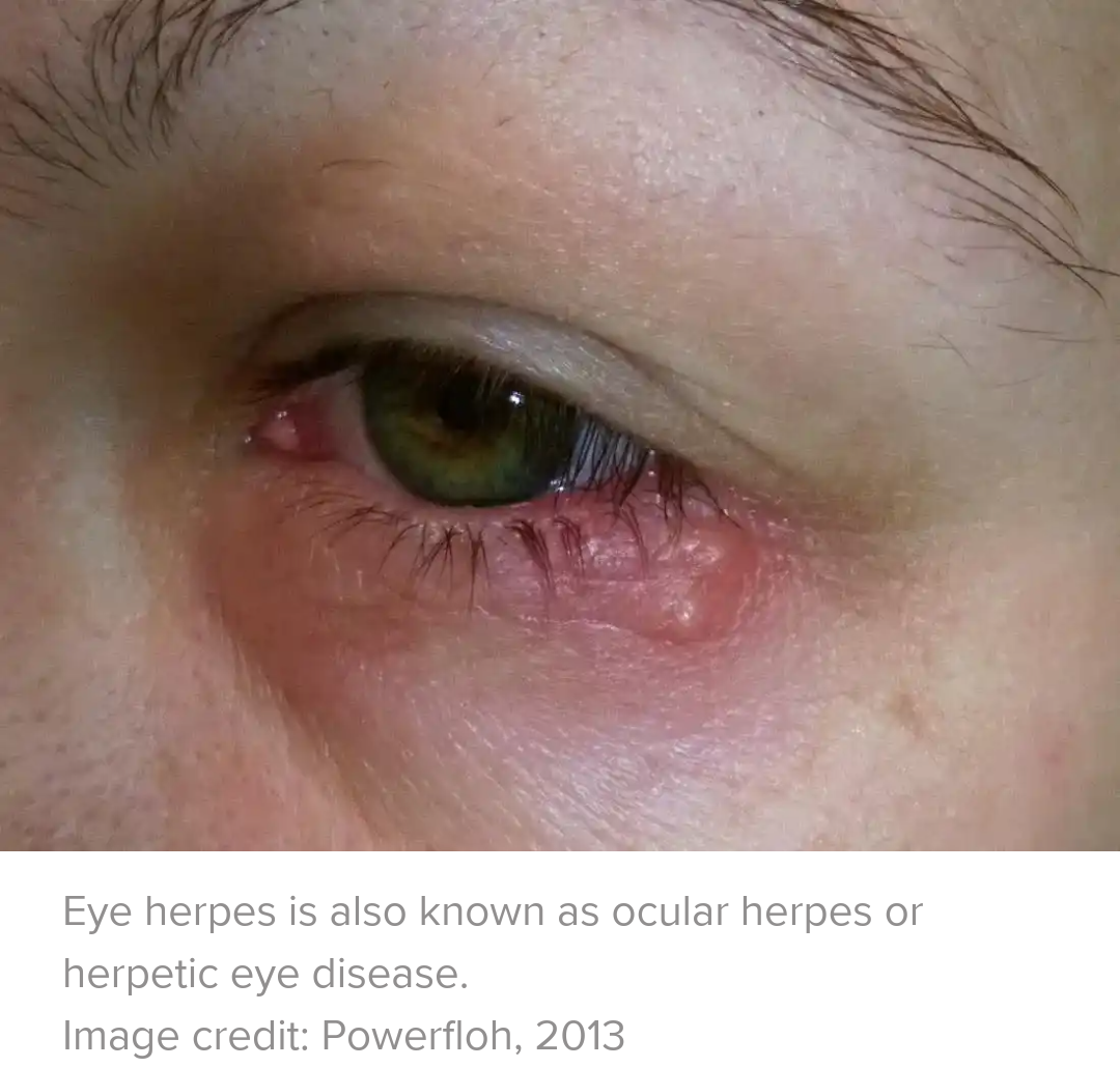 Herpes and the eyes